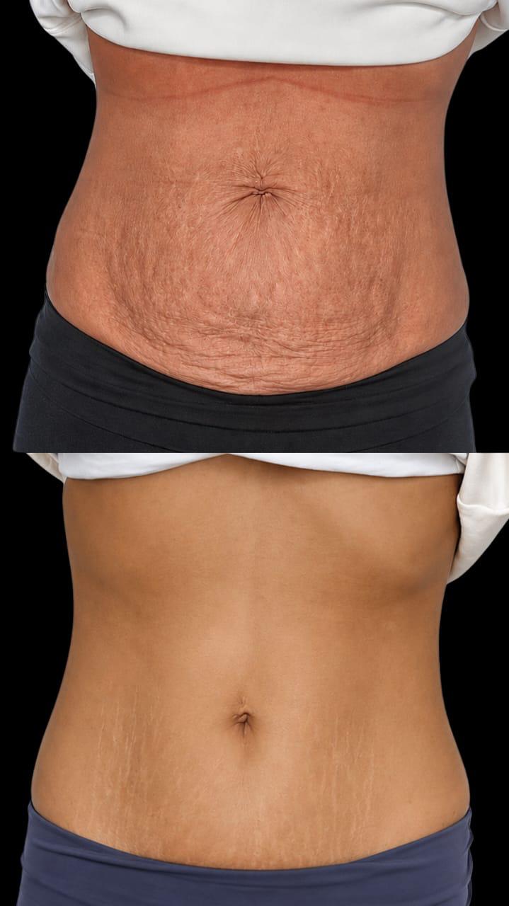 Antes e depois de cuidado corporal em região abdominal