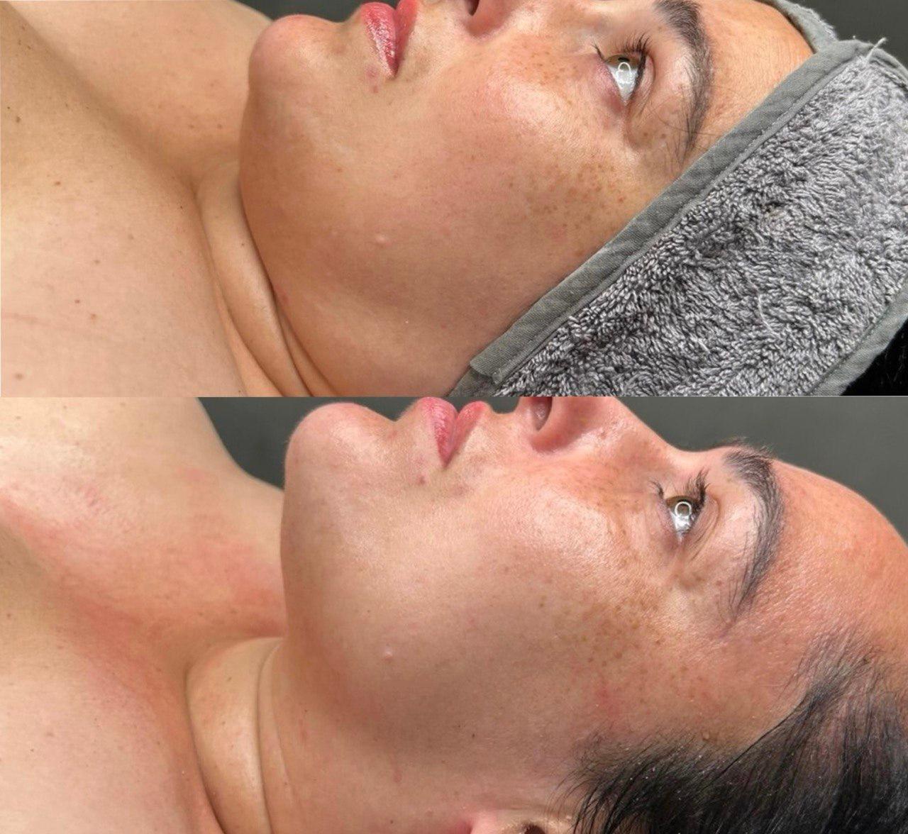 Antes e depois de cuidado facial com abordagem enzimática